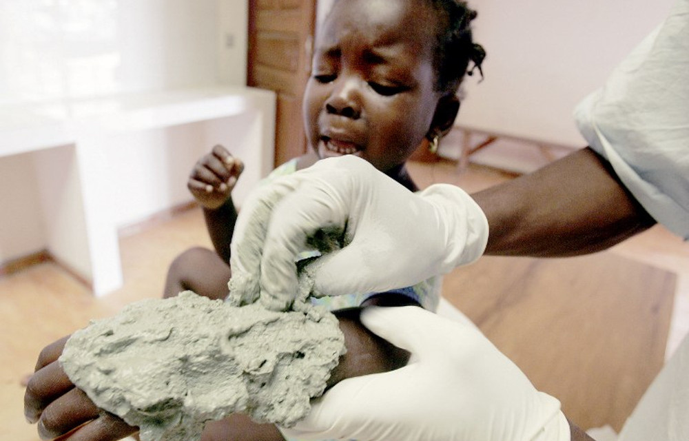 Buruli ulcer: Africa’s neglected but third most common mycobacterial disease