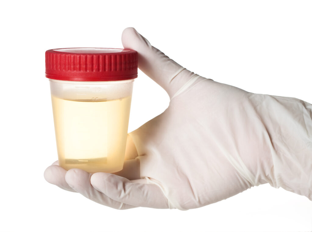 Urine Sample In Hand, Isolated