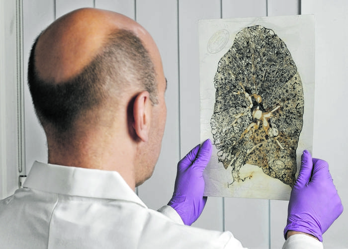 Laminated section of diseased lung tissue, 1978.