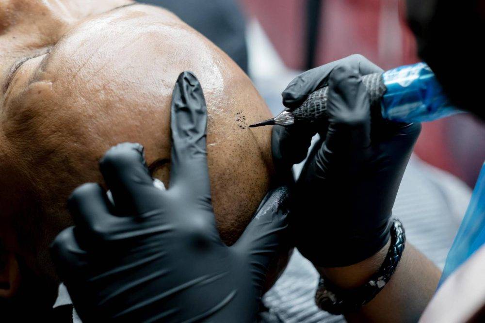 Ink-credible Solutions: The Art and Science of Scalp Micropigmentation